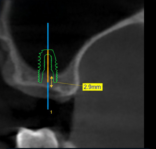 Preoperative digital planning for implant placement