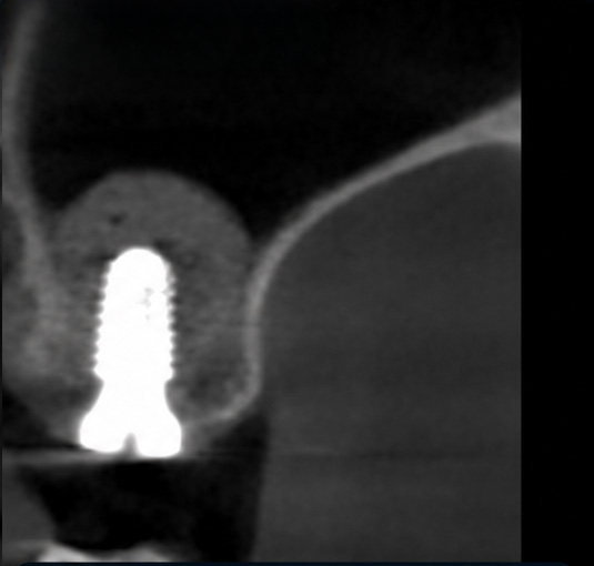 Clinical implant placement following preoperative planning