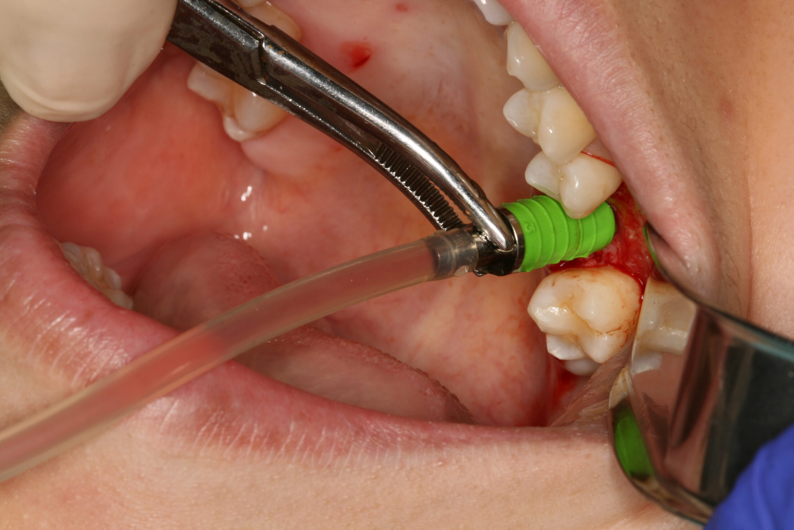 Sinus elevation during the crestal augmentation workflow