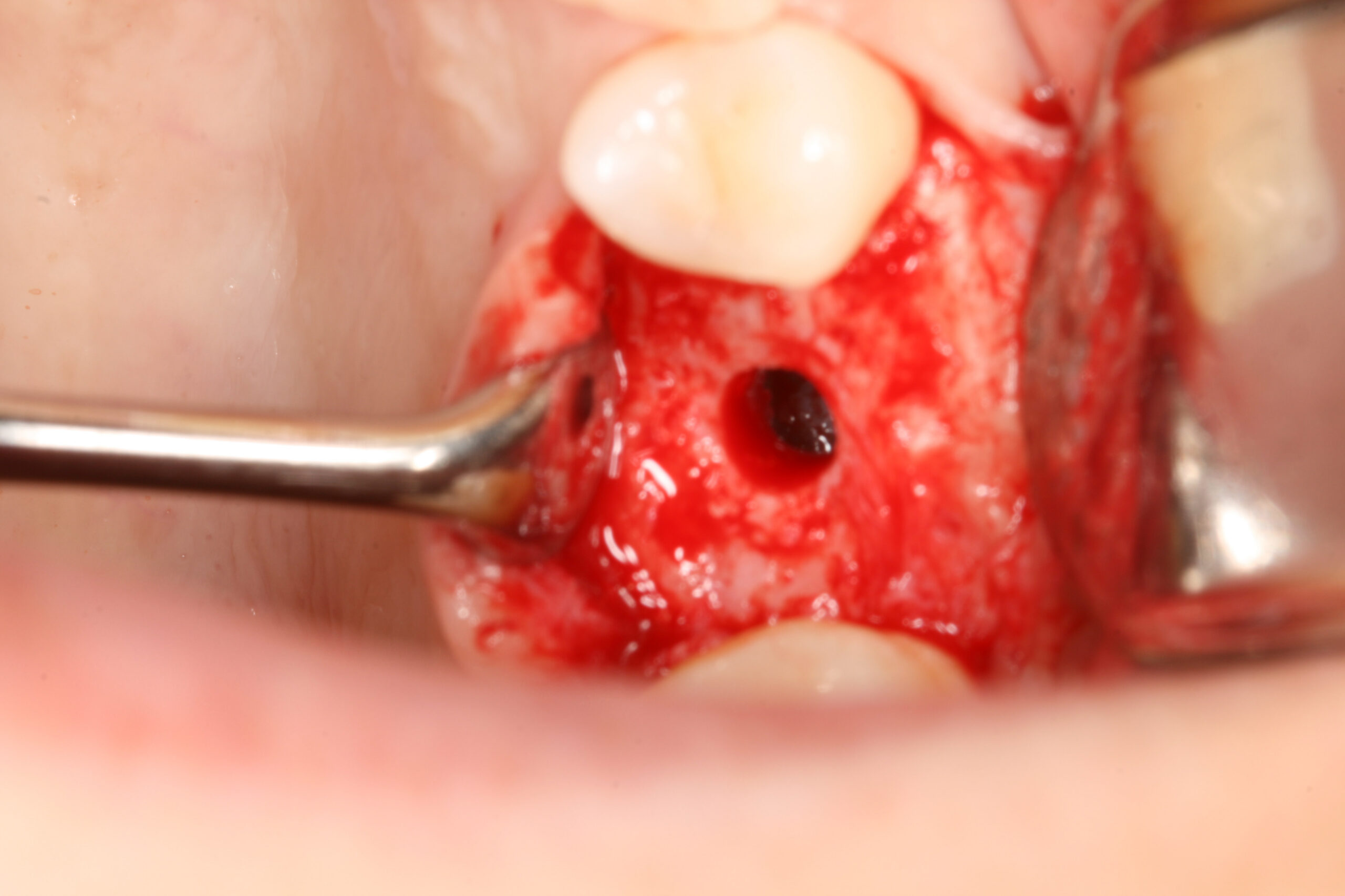 Osteotomy preparation during crestal sinus augmentation
