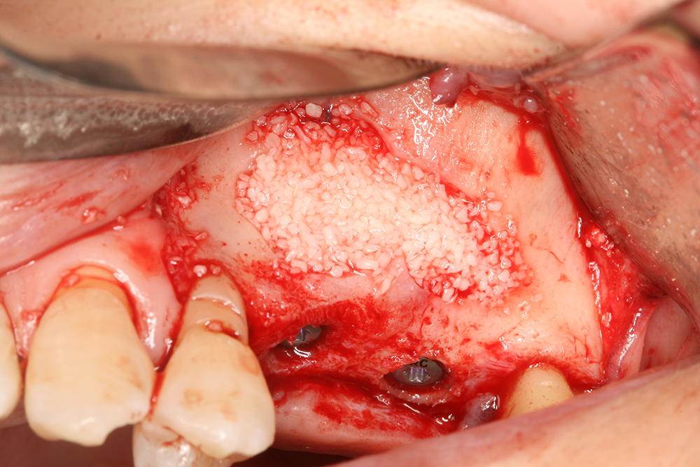 Graft placement during lateral sinus augmentation