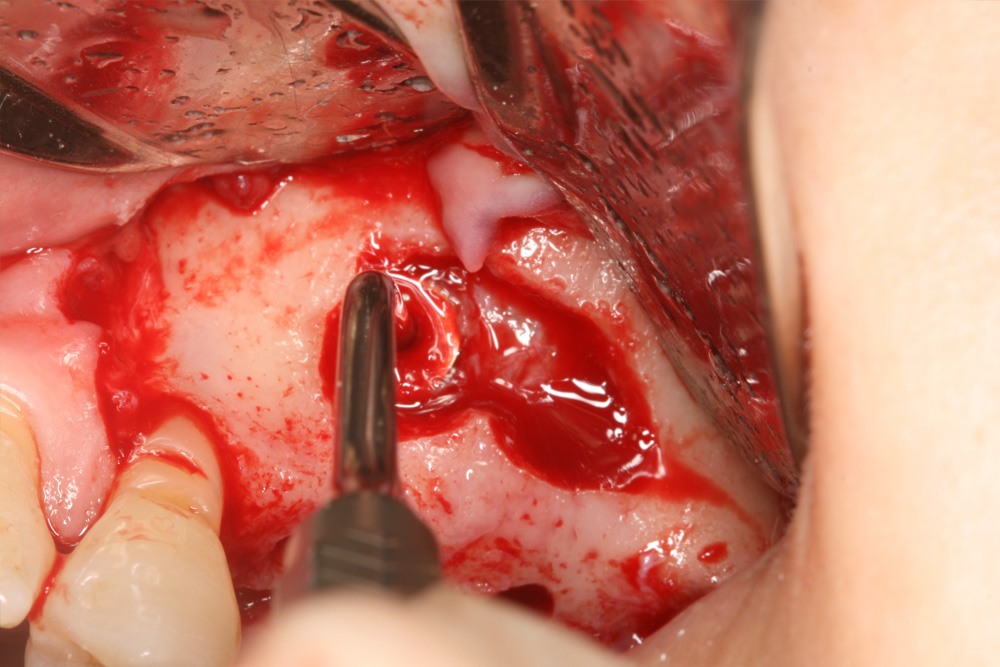 Preoperative view before lateral sinus augmentation