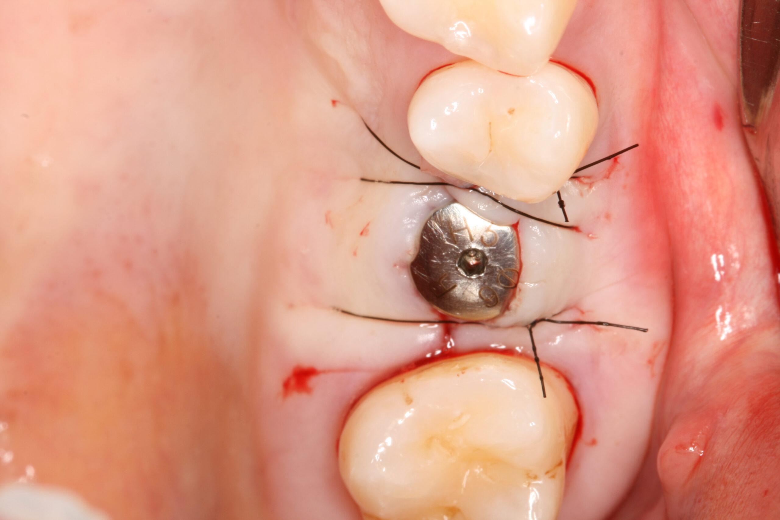 Closure after crestal sinus augmentation and implant placement