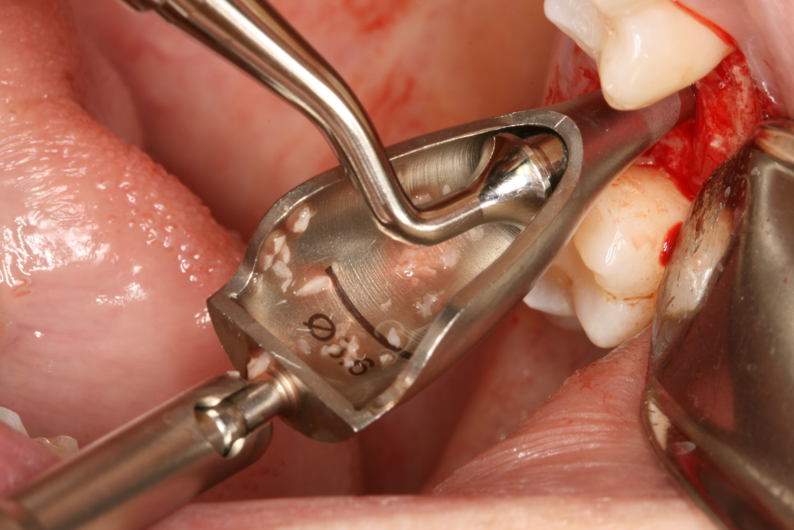 Graft placement during crestal sinus augmentation