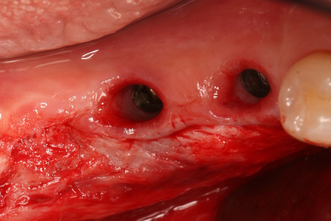 Case 03: apically positioned flap around two implants