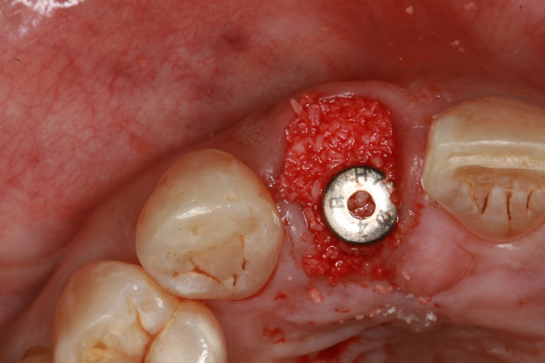 Case 01: dual zone graft packed around the immediate implant