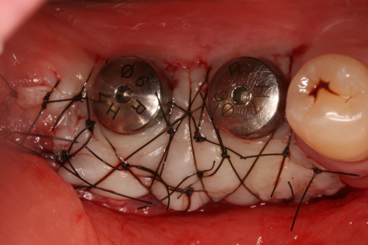 Case 03: free gingival graft fixed around two implants with 5-0 sutures