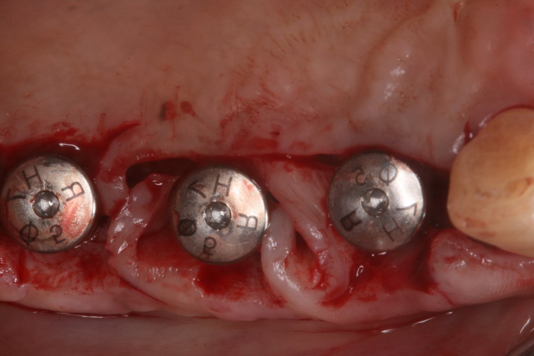 Case 04: flap adapted around three implants
