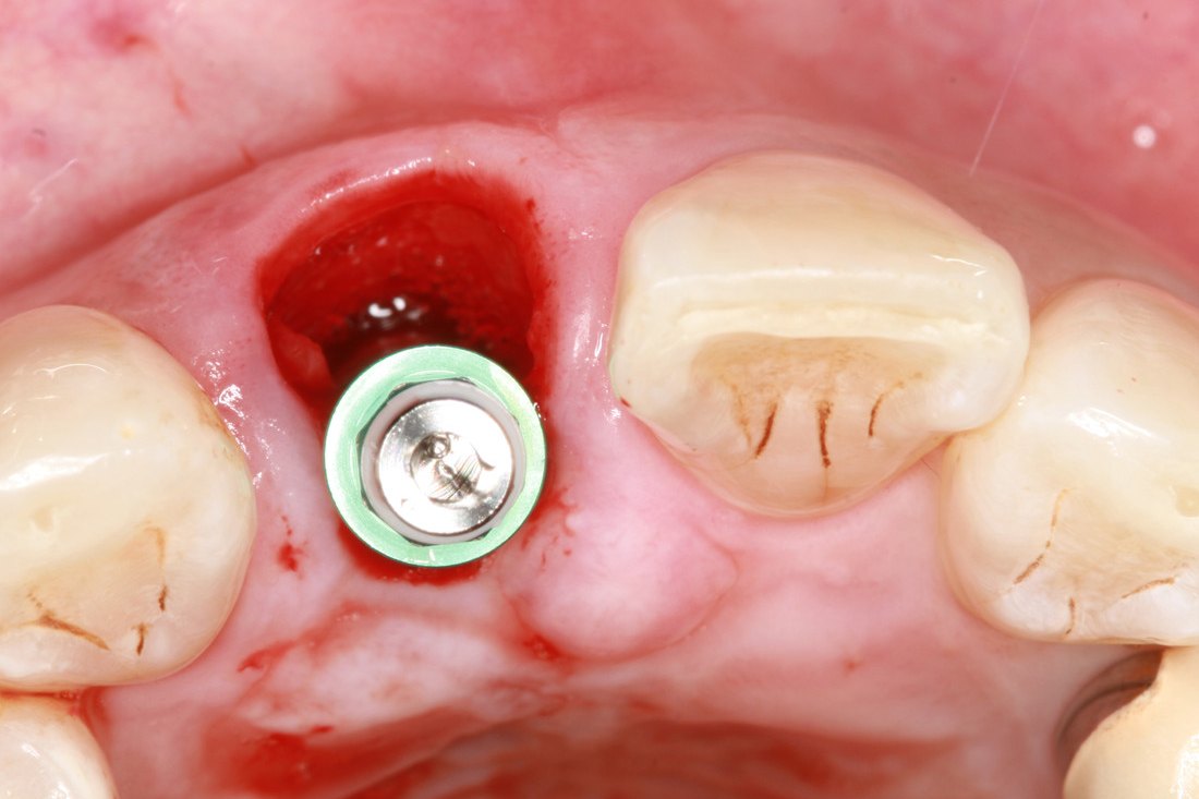 Case 01: immediate implant placed in a fresh extraction socket
