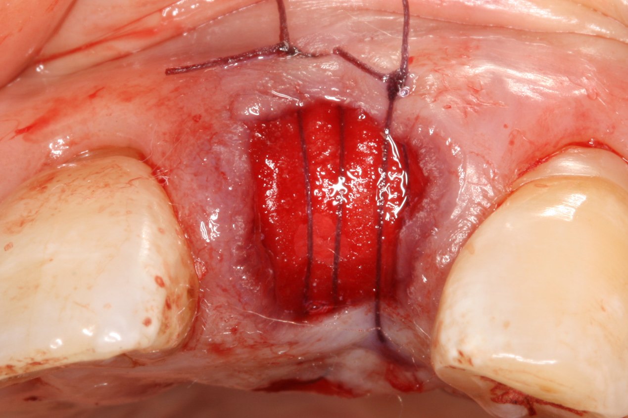 Case 02: grafted socket covered with a resorbable membrane and sutured